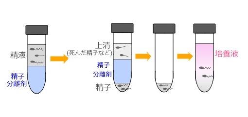 去医院洗精要花多少钱？