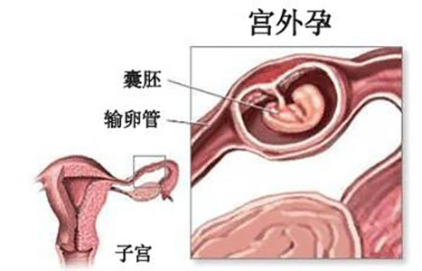 宫外孕可通过俄罗斯试管婴儿技术避免