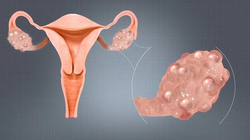多囊卵巢综合征患者科学备孕指南||多囊患者可通过美国试管婴儿技术怀上健康小宝宝！
