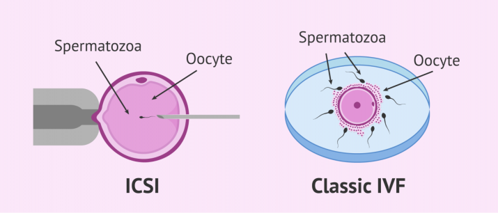 单一精虫显微注射术(ICSI)与体外受精(IVF)对不孕症治疗的效果