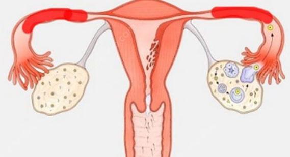 输卵管堵塞原因有哪些？可以通过泰国试管婴儿技术怀宝宝吗？