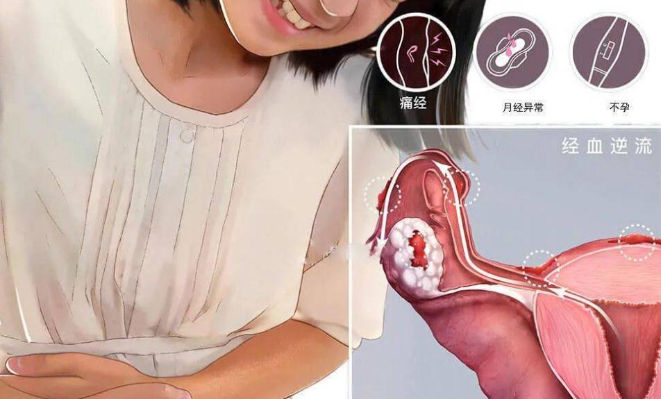 子宫内膜异位不孕原因：可通过美国试管婴儿技术解决！
