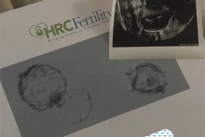 天津40岁客人国内试管失败赴美治疗成功怀孕