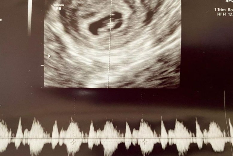 南京客人移植后第30天B超监测到胎心胎芽