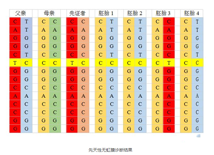 案例分享：先天性无虹膜通过3代试管婴儿技术避免遗传