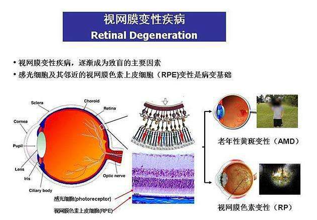 色素性视网膜炎遗传几率高吗？可通过3代技术避免遗传！