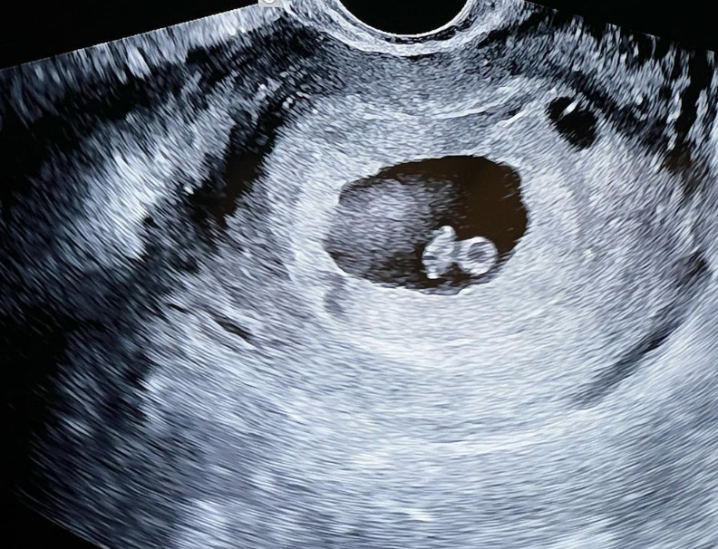 天津客人卵巢囊肿赴美做三代试管婴儿成功怀孕